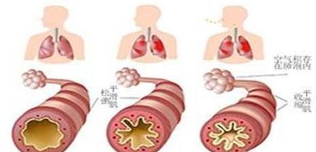 支氣管哮喘如何根治，試試這幾個(gè)哮喘偏方