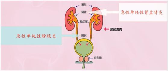 為什么有些人性生活后有尿感？有些人性生活后尿感的主要原因