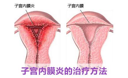 子宮內(nèi)膜炎癥狀_什么原因?qū)е伦訉m內(nèi)膜炎癥狀