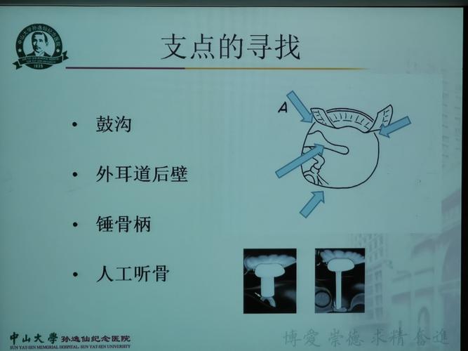 鼓室注射有什么副作用(鼓室注射有什么副作用和危害)