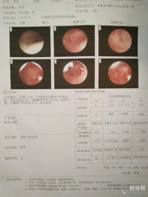 害怕宮腔鏡手術副作用-做宮腔鏡手術副作用