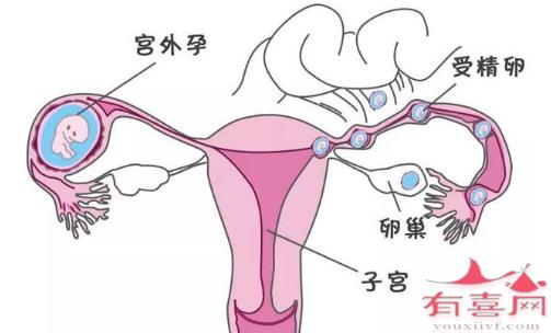 宮外孕有哪些癥狀(孕早期宮外孕有哪些癥狀)