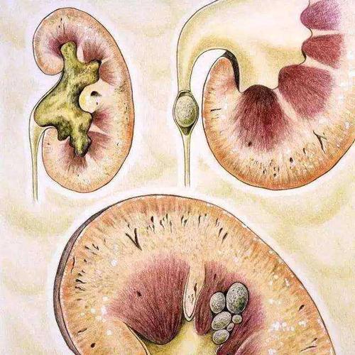 腎結(jié)石的癥狀_腎結(jié)石的癥狀有哪些癥狀女性