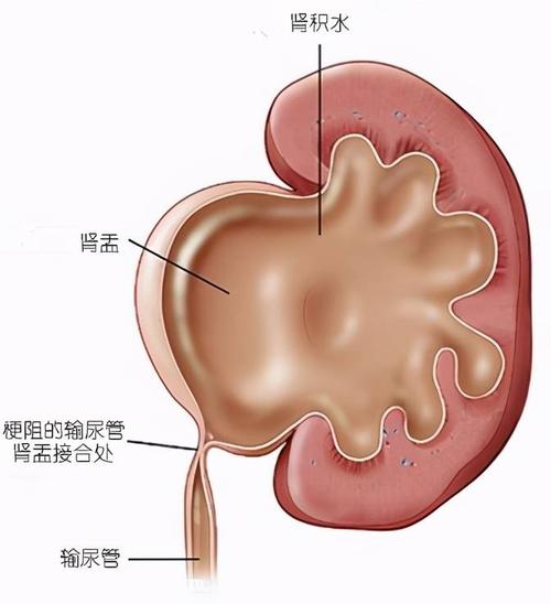 腎積水癥狀,孕婦腎積水癥狀