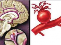 腦血管痙攣癥狀,腦血管痙攣癥狀是什么引起的