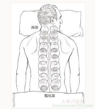 抑郁、煩悶別著急，用火罐拔走